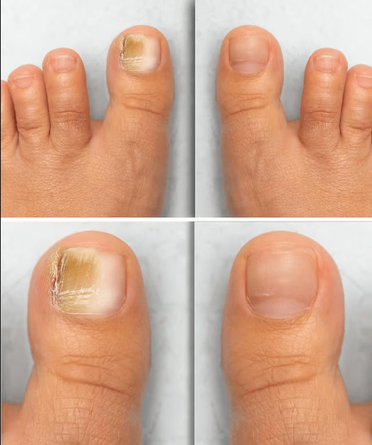 Foot fungus - before and after treatment with fungeent cream
