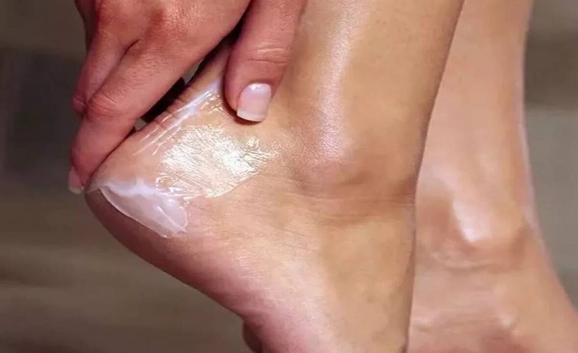 How to treat foot mushroom with fungent cream