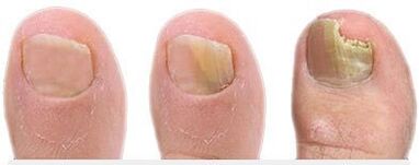 Stages of the development of fungus on the nails