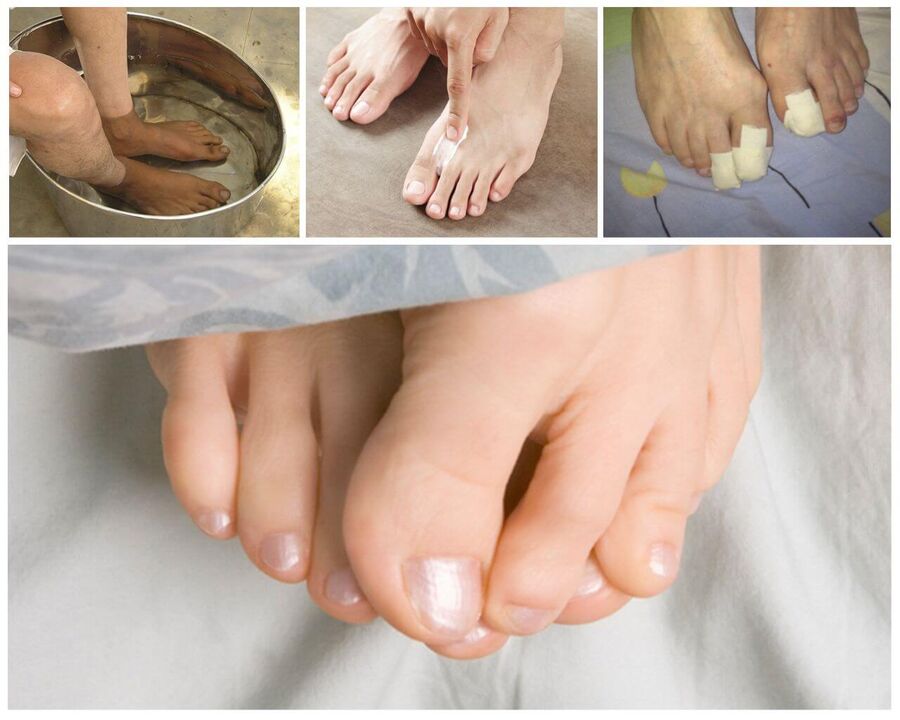Treatment of fungus