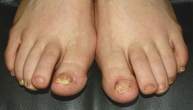 Signs and symptoms of fungus on the nails