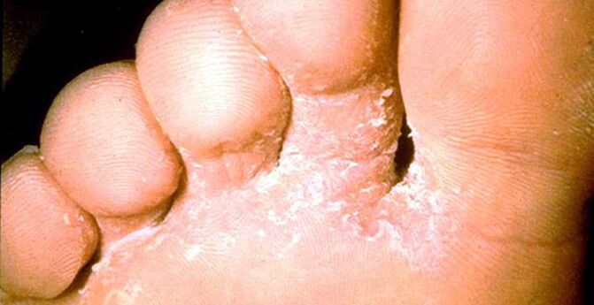 Lesion of the skin fungus between the toes