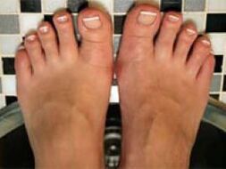 fungus on nails and skin of the legs
