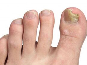 yellow spots on the nails of the foot-signs of fungus