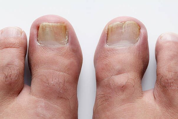 type of toenail fungus