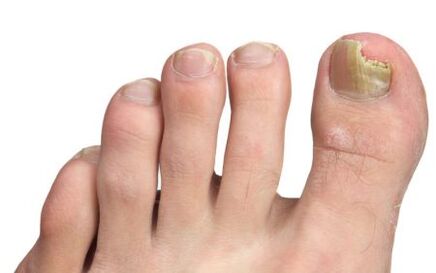 fungus on the big toe nail