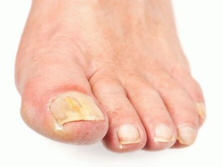 nail fungus damage