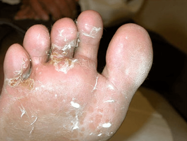 development of fungus on the toes
