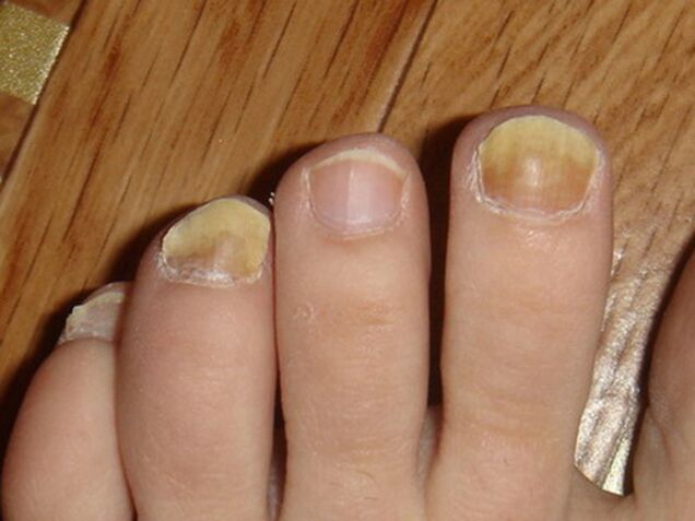 symptoms of fungus on toenails