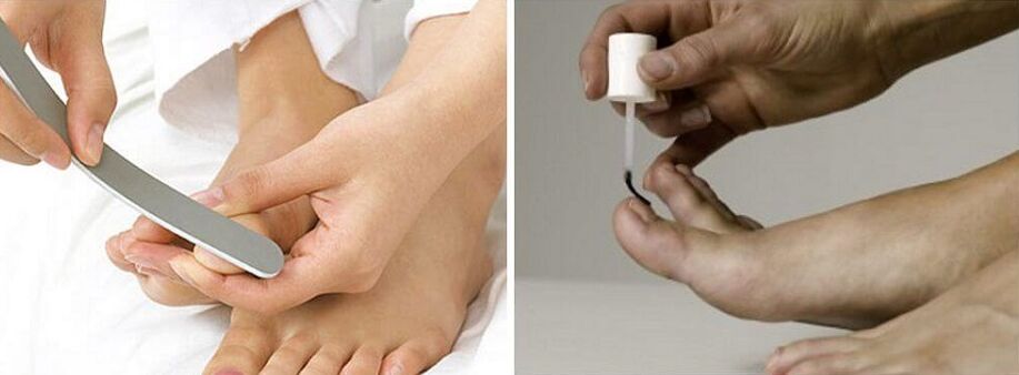 treatment of fungus on toenails with varnish