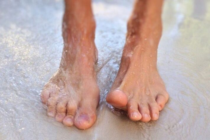Walking barefoot as a way to get nail fungus